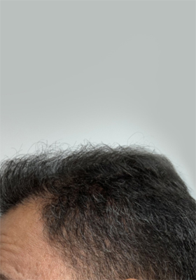 hair transplant before after Photos