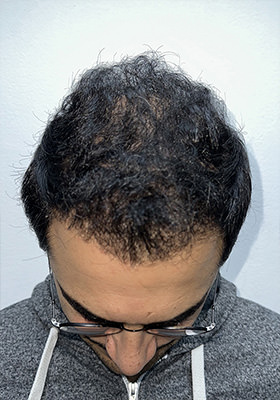 hair transplant before after Photos