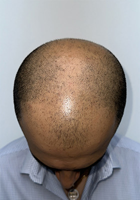 hair transplant before after Photos