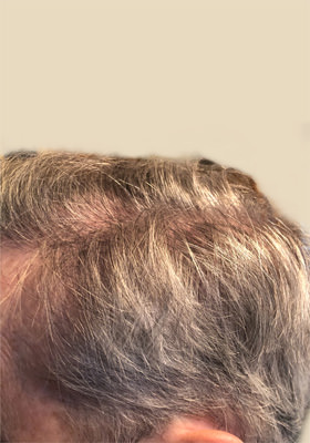 hair transplant before after Photos