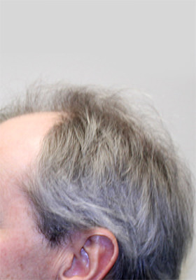 hair transplant before after Photos