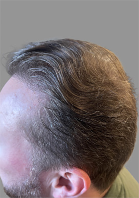 hair transplant before after Photos