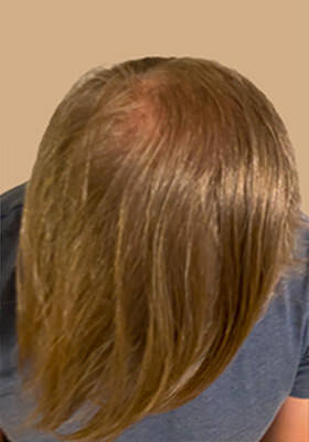 hair transplant before after Photos