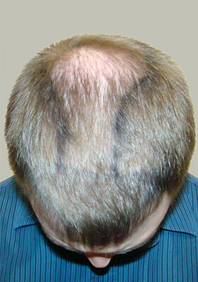 hair transplant before after Photos