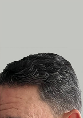 hair transplant before after Photos