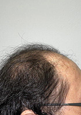 hair transplant before after Photos