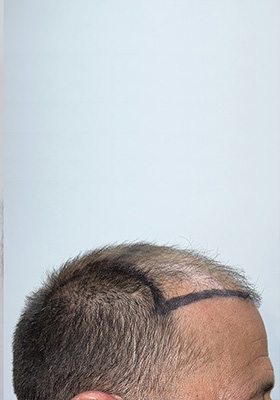 hair transplant before after Photos