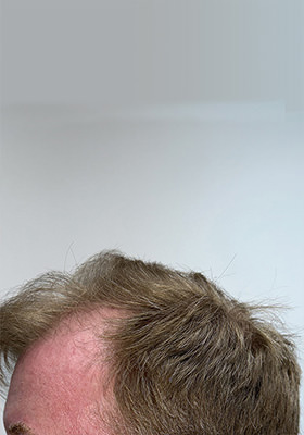 hair transplant before after Photos