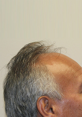 hair transplant before after Photos