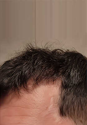 hair transplant before after Photos