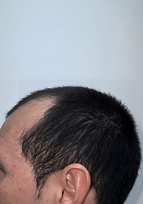 hair transplant before after Photos