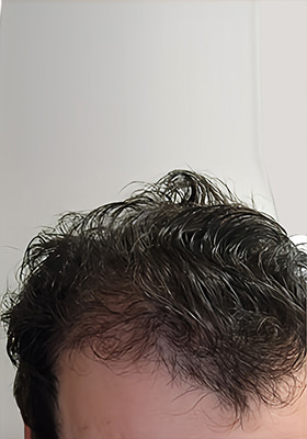 hair transplant before after Photos