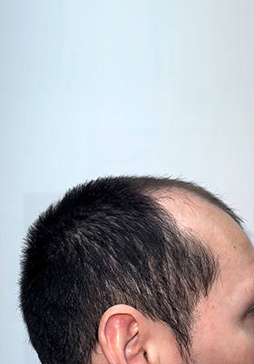 hair transplant before after Photos