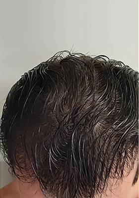 hair transplant before after Photos