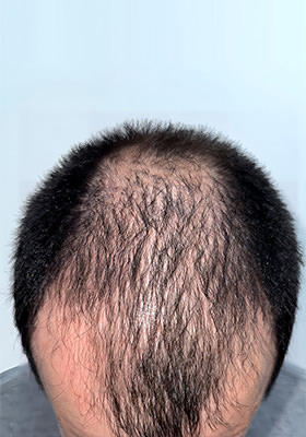 hair transplant before after Photos