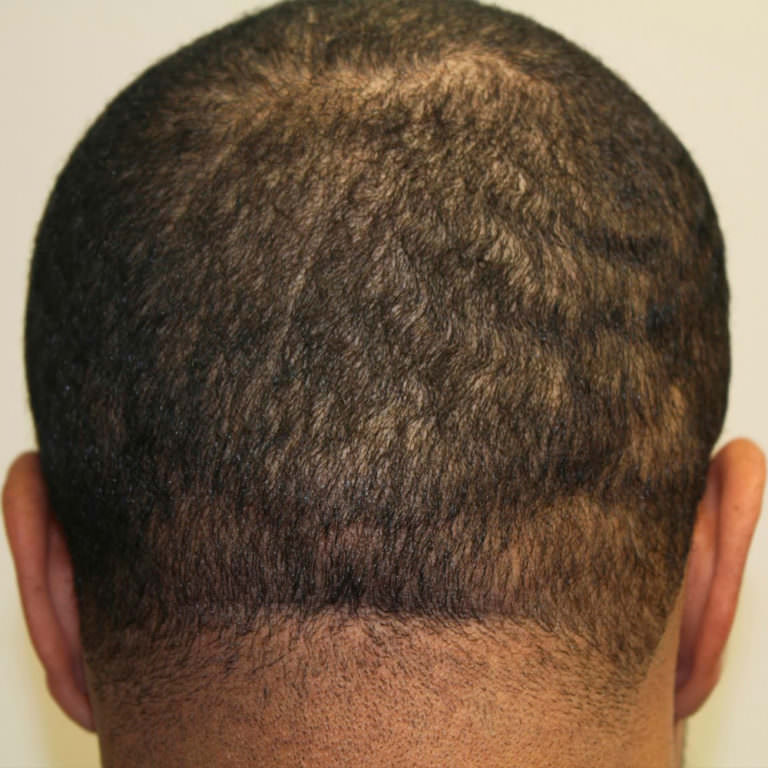 Can You Find This Scar After Our FUT Hair Transplant? - Dr. Brett ...