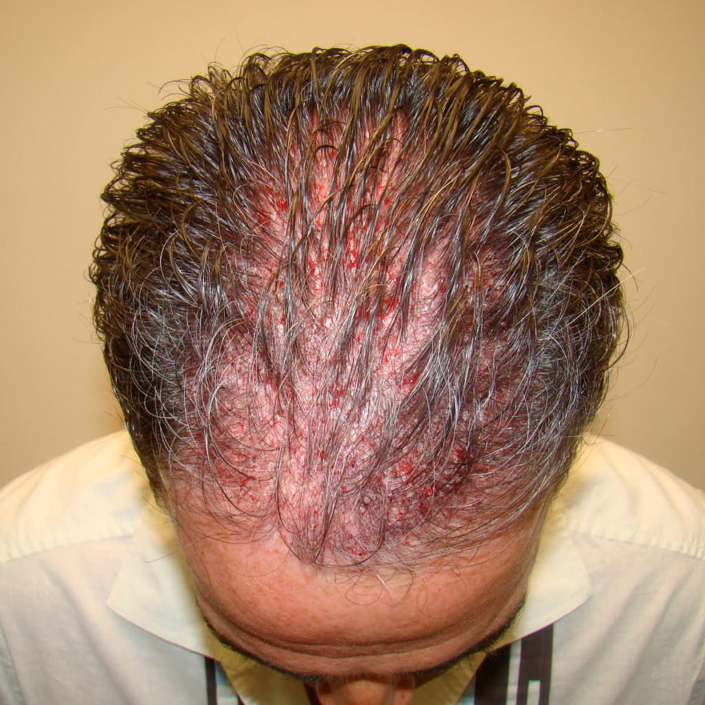 How Long Is Healing After Hair Transplant