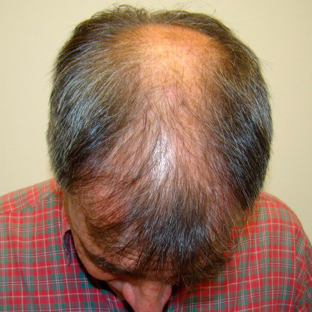 Large Balding Area? 1 MaxHarvest™ Hair Transplant Before And After ...