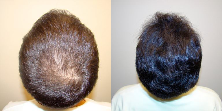 Young Man's Hairline and Crown Restoration - Dr. Brett Bolton's Latest News