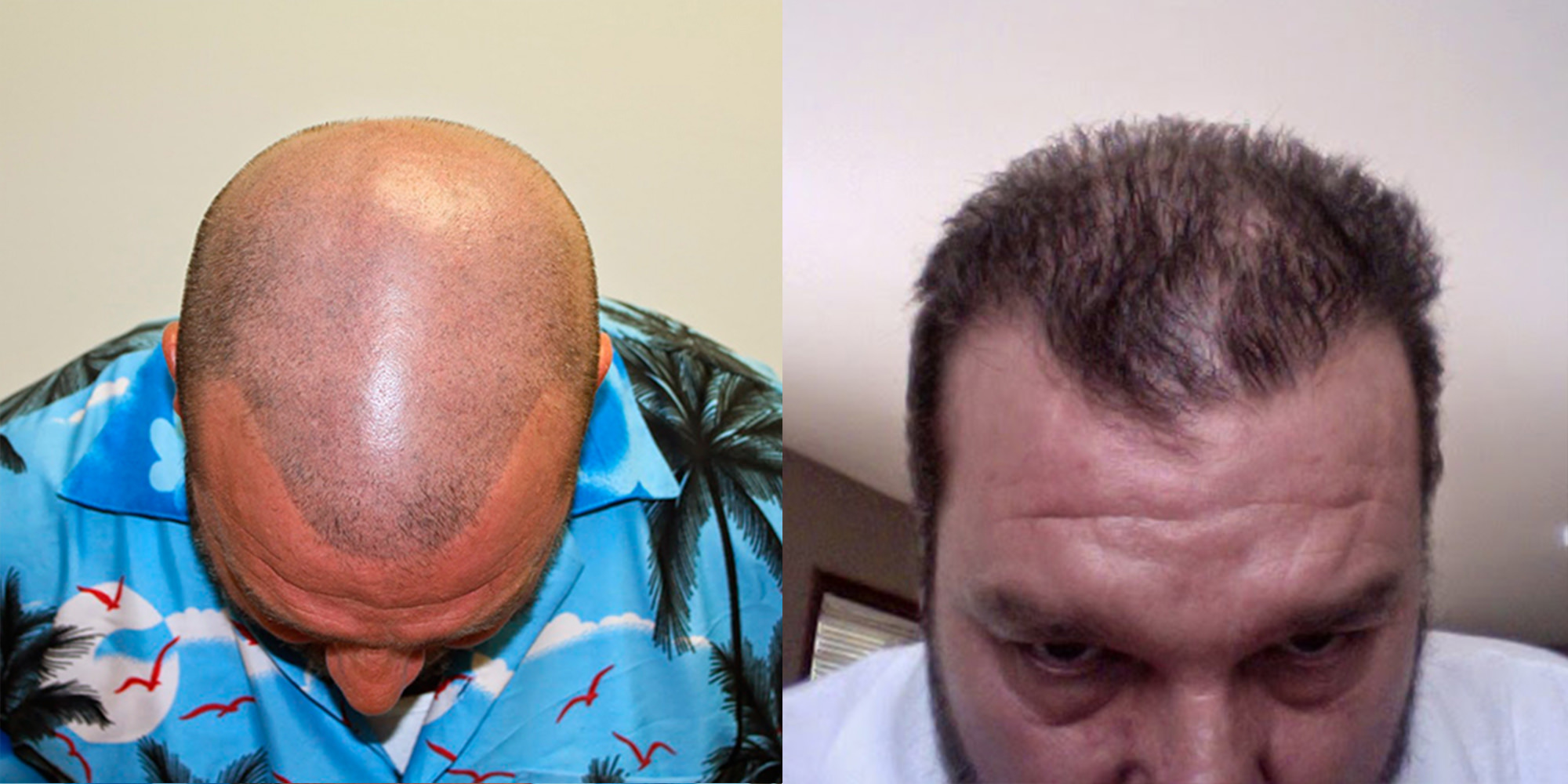Dr. Brett Bolton's Latest Hair Transplant Reviews , News and Updates 2024