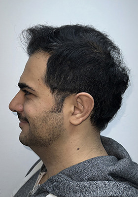 hair transplant photos