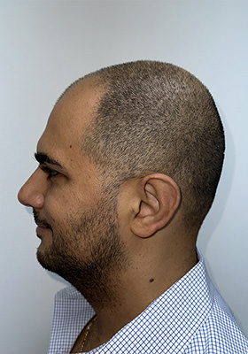 hair transplant photos