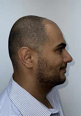 hair transplant photos