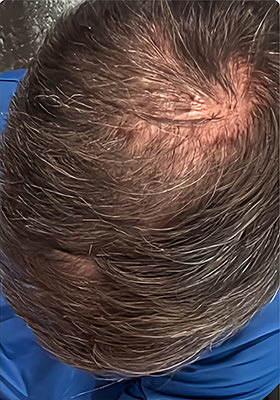 hair transplant photos