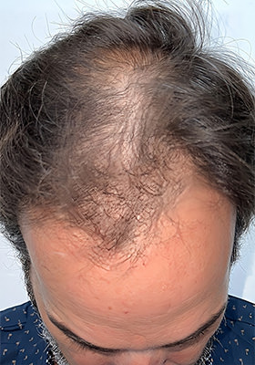 hair transplant before after Photos