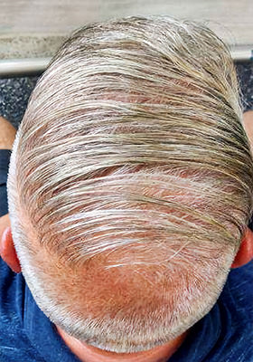 hair transplant photos