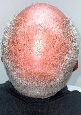 hair transplant before after Photos