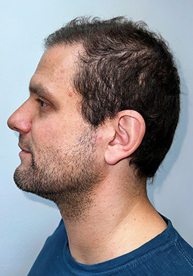 hair transplant photos