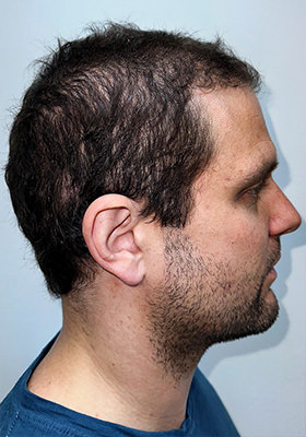 hair transplant photos