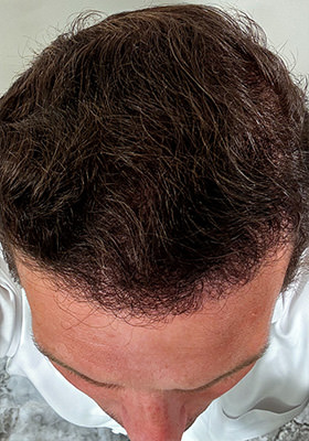 hair transplant before after Photos