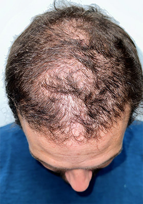 hair transplant before after Photos