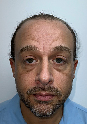 hair transplant before after Photos