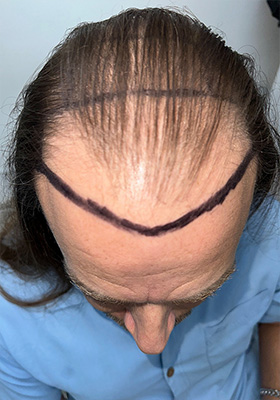 hair transplant before after Photos
