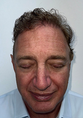 hair transplant before after Photos