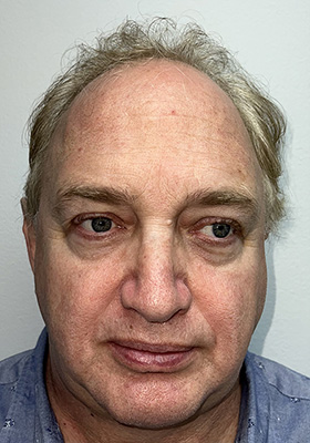 hair transplant before after Photos