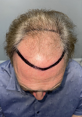 hair transplant before after Photos