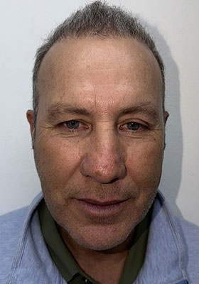 hair transplant before after Photos