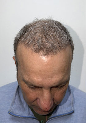 hair transplant before after Photos