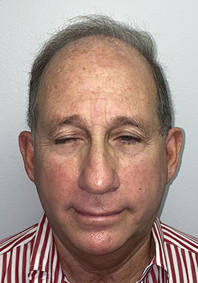 hair transplant before after Photos