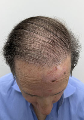 hair transplant before after Photos