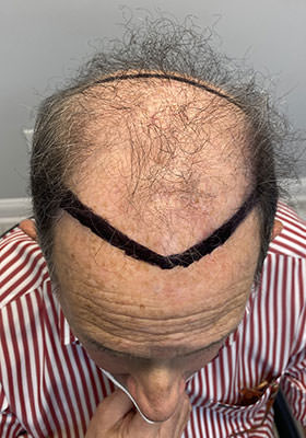 hair transplant before after Photos