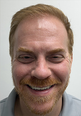 hair transplant before after Photos