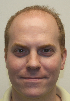 hair transplant before after Photos