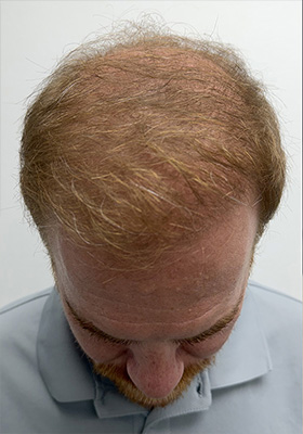 hair transplant before after Photos