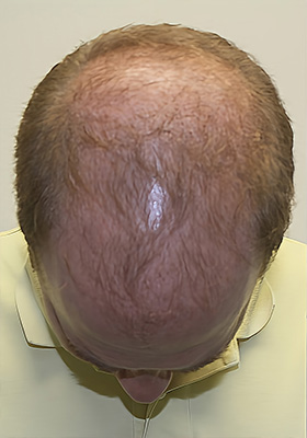 hair transplant before after Photos