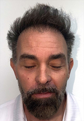 hair transplant before after Photos